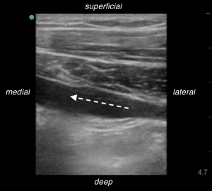 emDOCs.net – Emergency Medicine EducationUS Probe: Ultrasound Guided ...