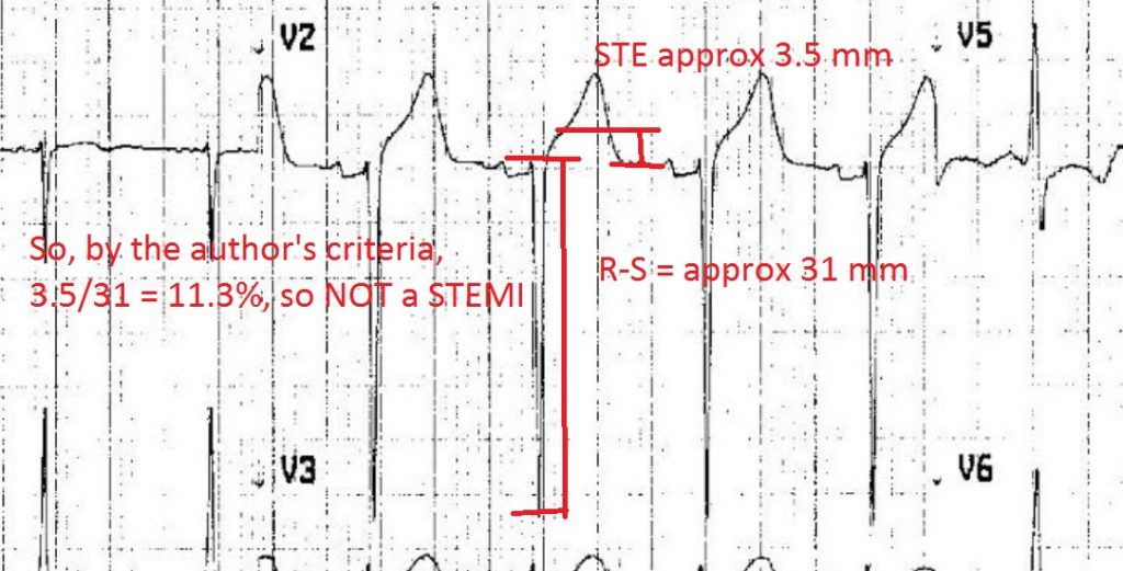 EmDOCs.net – Emergency Medicine EducationECG Pointers: LVH Vs STEMI ...