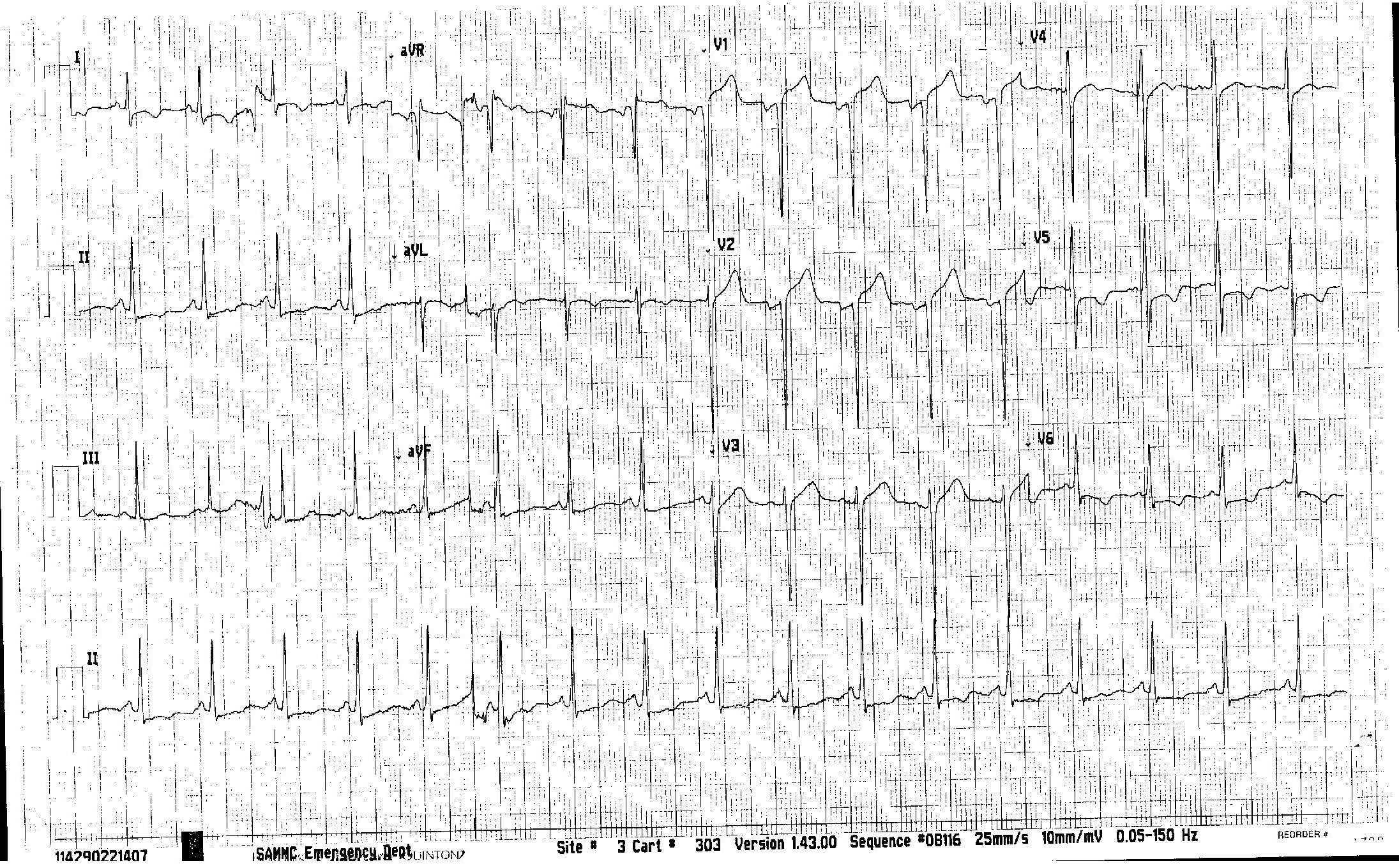 EmDOCs.net – Emergency Medicine EducationECG Pointers: LVH Vs STEMI ...