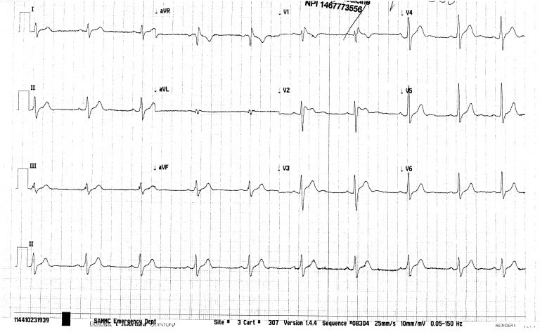 emDOCs.net – Emergency Medicine EducationECG_Brugada 1 - emDOCs.net ...