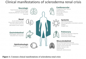 emDOCs.net – Emergency Medicine EducationScleroderma Renal Crisis: Not ...