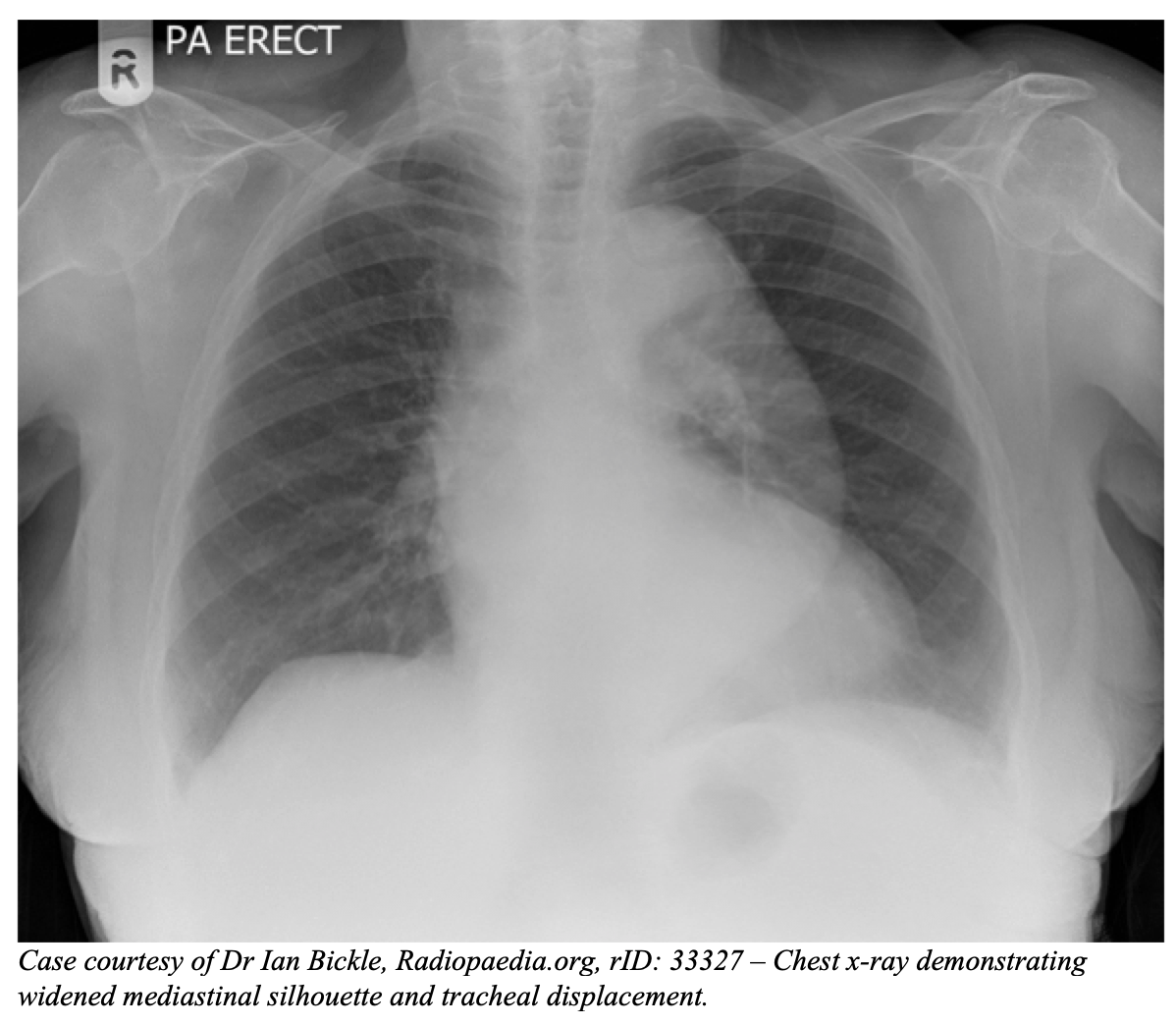 emDOCs.net – Emergency Medicine EducationThoracic Aortic Aneurysms ...