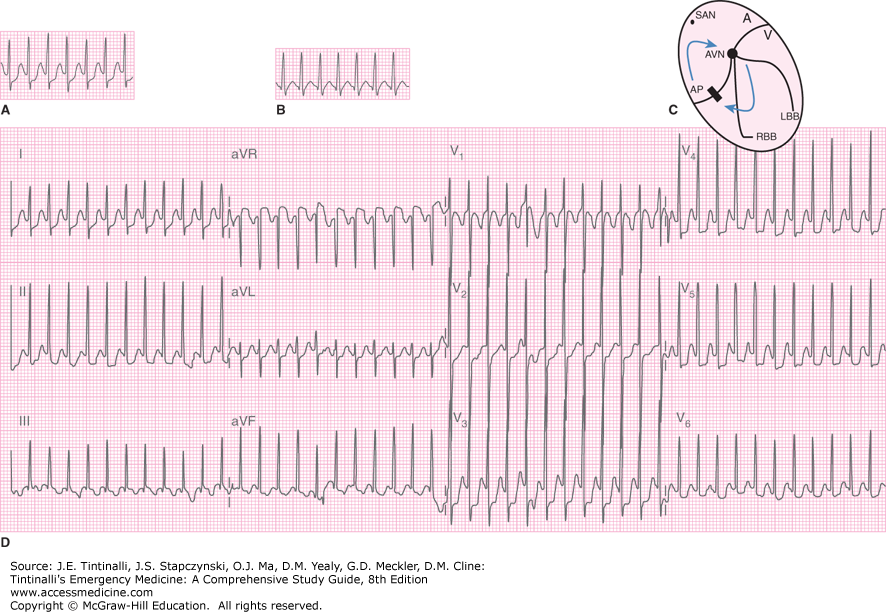 EmDOCs.net – Emergency Medicine EducationECG Pointers: Syncope And ...