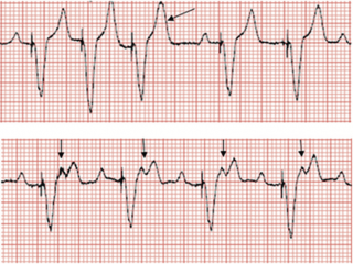 emDOCs.net – Emergency Medicine EducationECG Pointers: Pacemakers ...