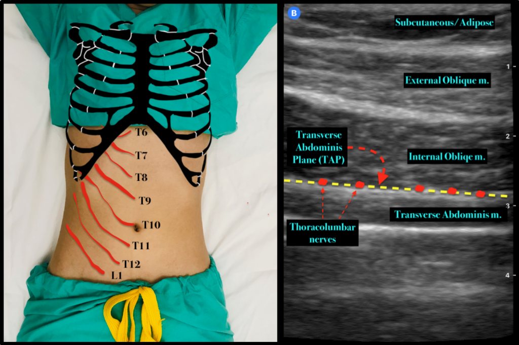 EmDOCs.net – Emergency Medicine EducationPain Profiles: ‘TAP IN ...