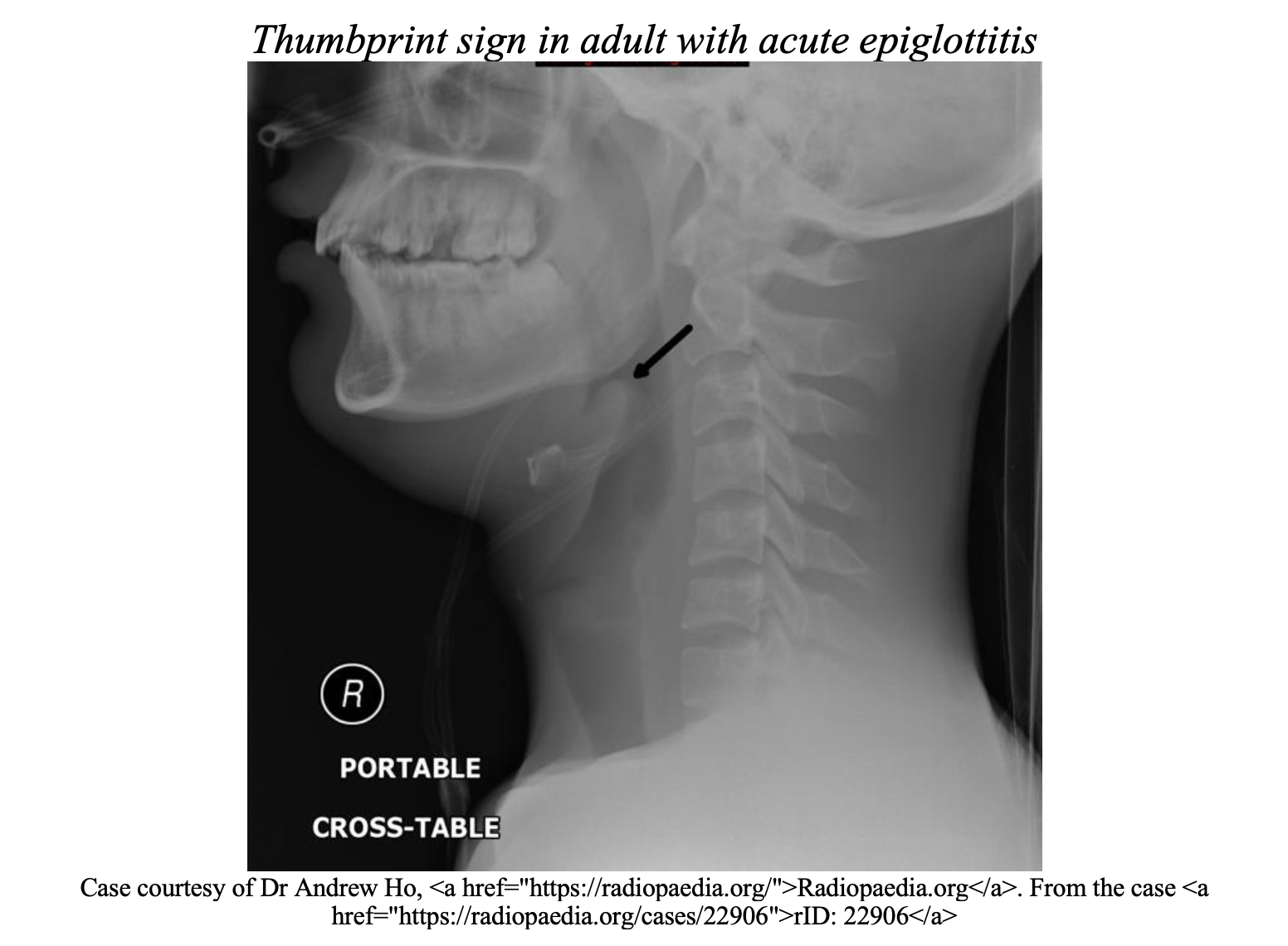 EmDOCs.net – Emergency Medicine EducationStridor: ED Presentations ...