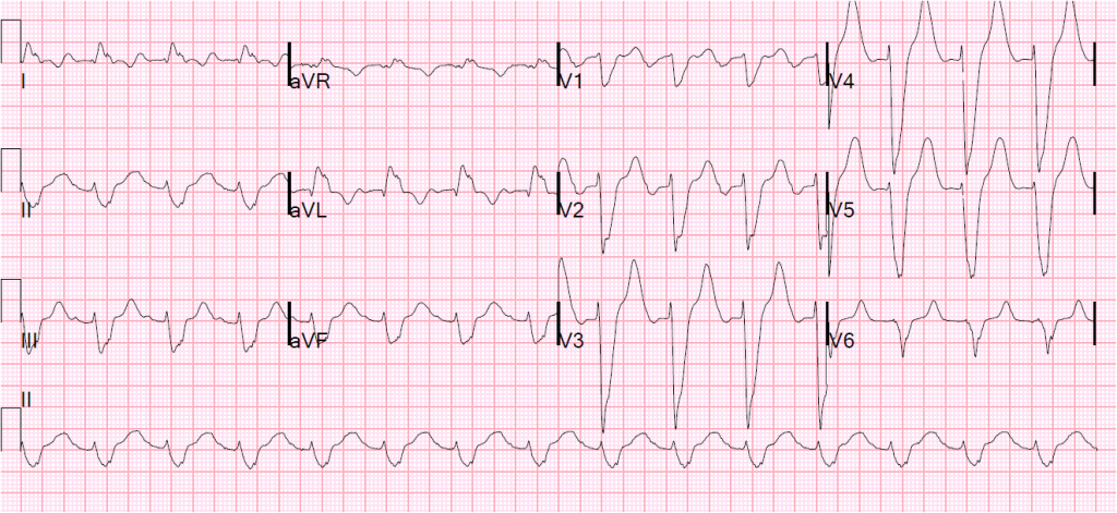 emDOCs.net – Emergency Medicine EducationECG Pointers: ICDs and when ...