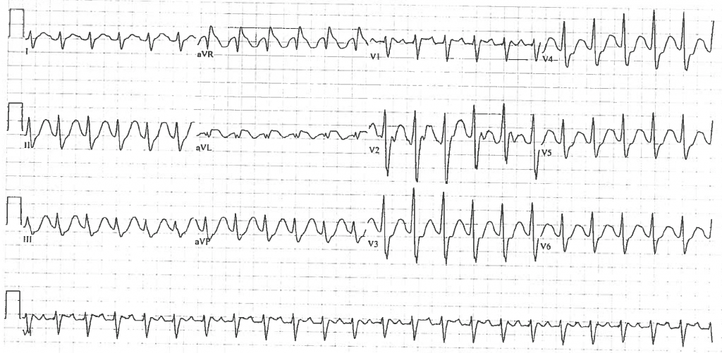 emDOCs.net – Emergency Medicine EducationTCA OD EKG - emDOCs.net ...