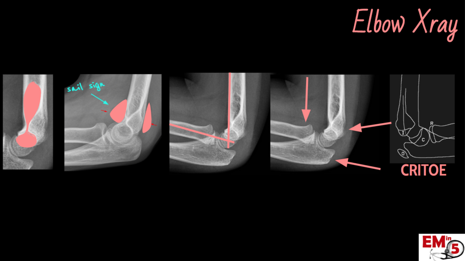 Xrays Elbow