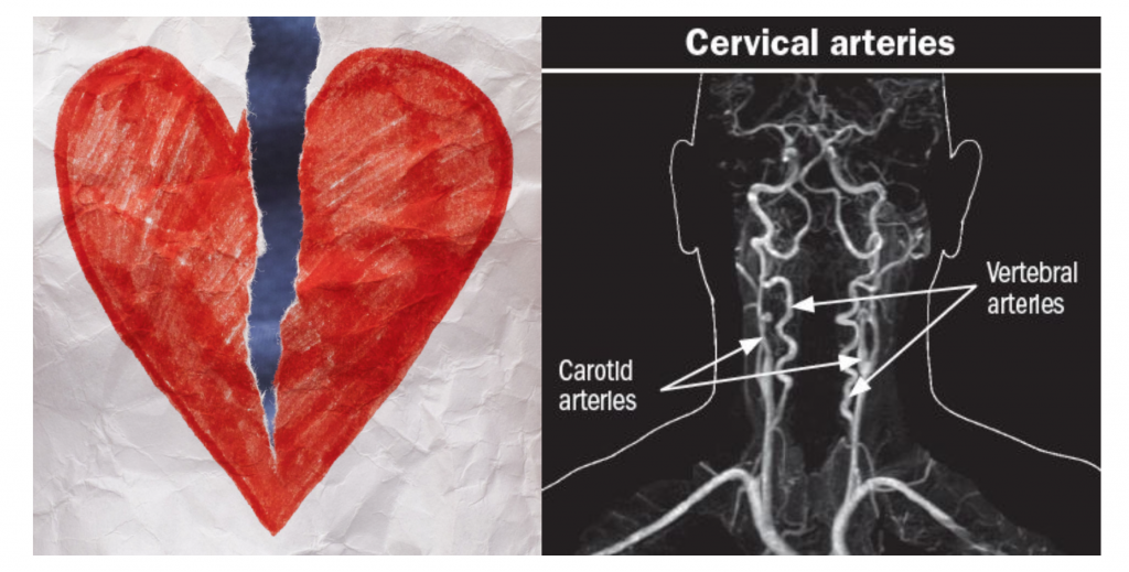 EmDOCs Net Emergency Medicine EducationCervical Artery Dissection The Elusive Diagnosis