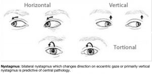 emDOCs.net – Emergency Medicine EducationPosterior Circulation Strokes ...