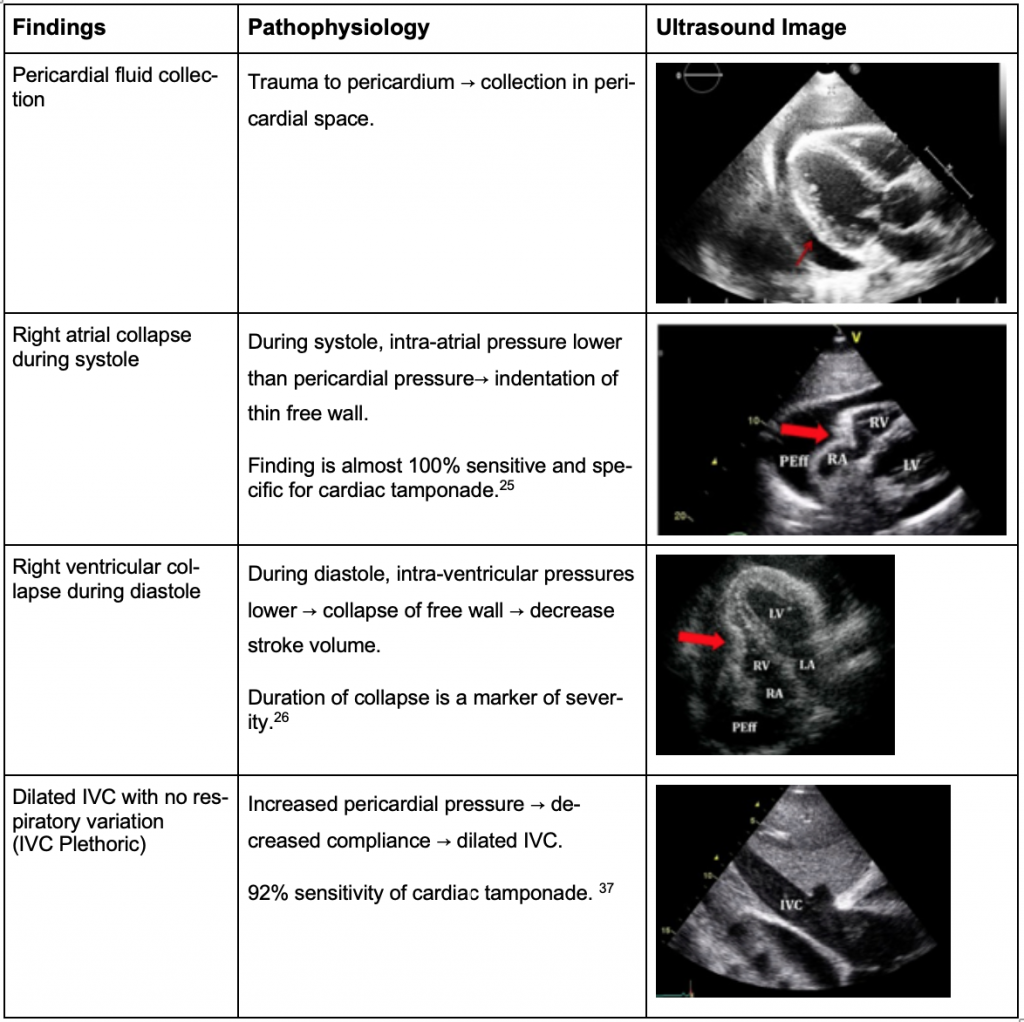 Pericardial Tamponade Ultrasound