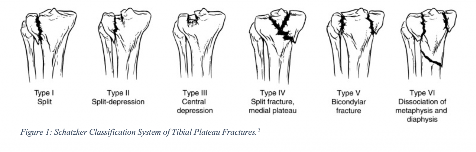 Emdocs Net Emergency Medicine Educationem Am Tibial Plateau