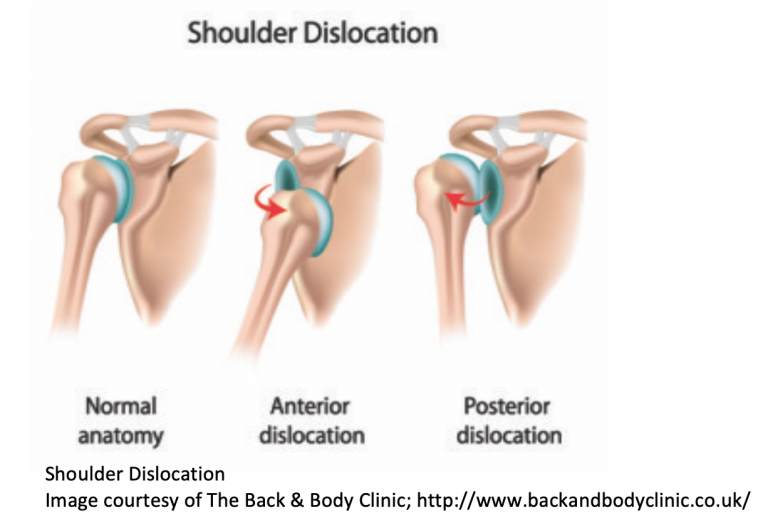 Emergency Medicine EducationEM3AM Posterior Shoulder