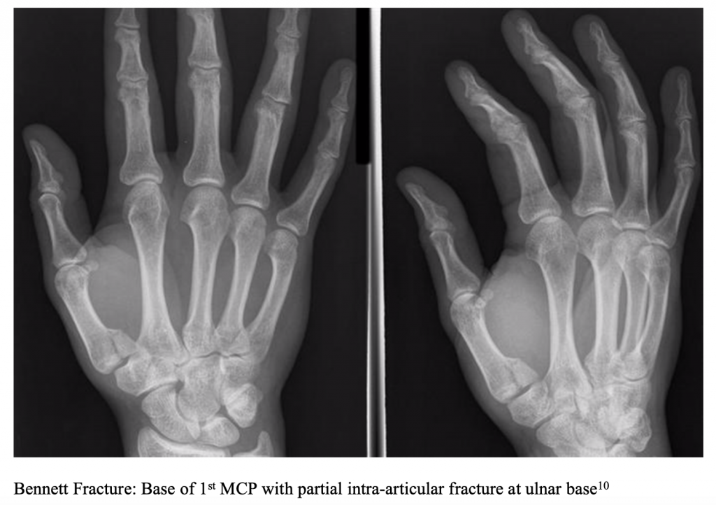 emDOCs.net – Emergency Medicine EducationEM@3AM: Metacarpal Base ...