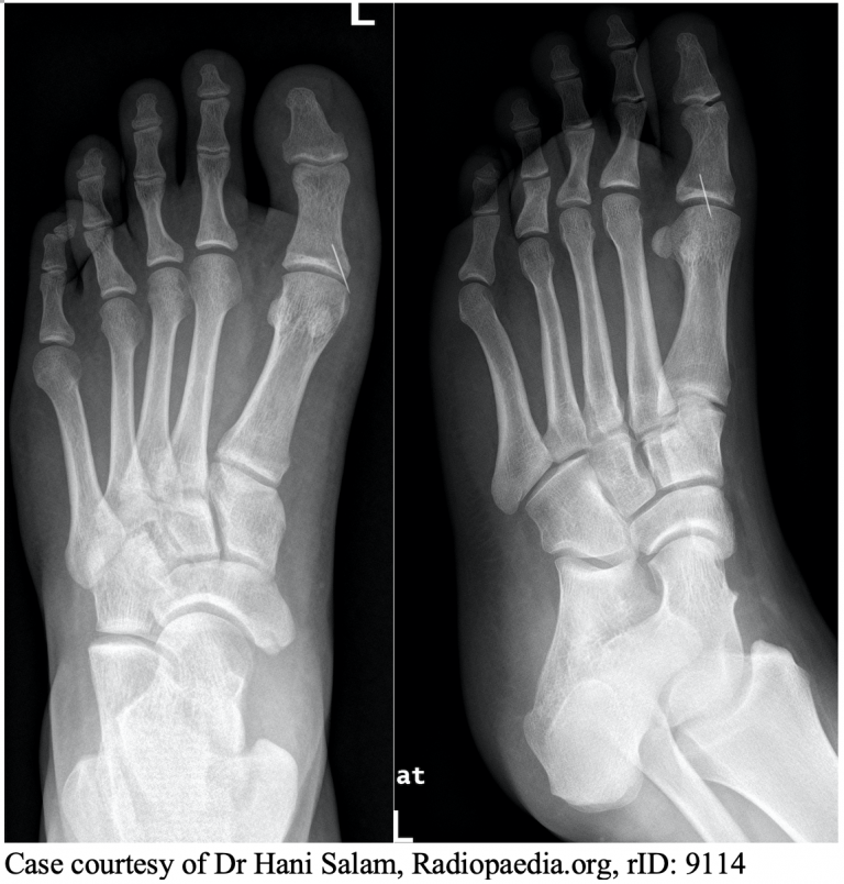 emDOCs.net – Emergency Medicine EducationPuncture Wounds: ED ...