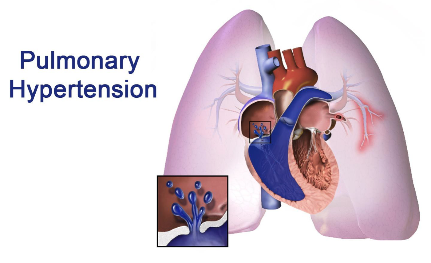 Легочное заболевание сердца. Pulmonary Hypertension, cor pulmonale. Pulmonary arterial Hypertension. Гипертензия легочной вены. Легочная артериальная гипертензия.