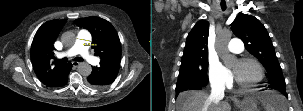 CT of the chest demonstrating evidence of Pulmonary hypertension