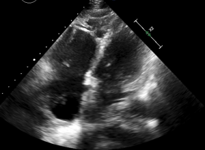 Right ventricular dilation on ultrasound