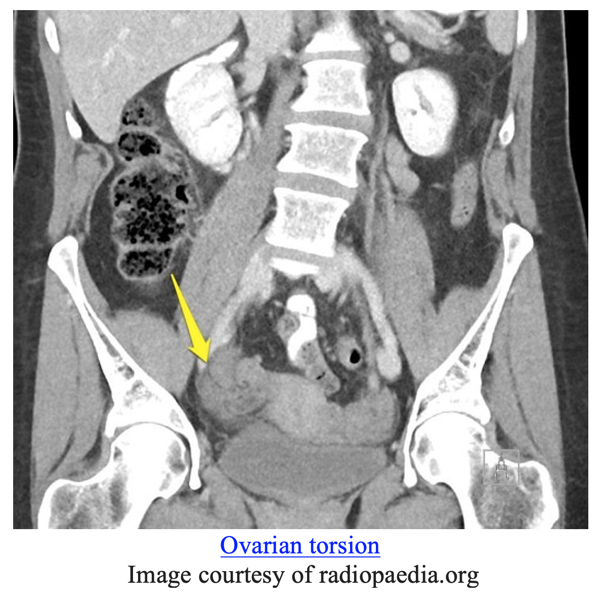 EmDOCs.net – Emergency Medicine EducationPelvic Ultrasound: Indications ...