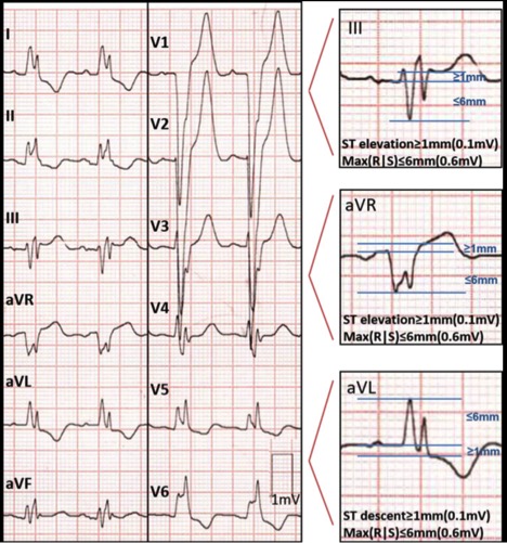 emDOCs.net – Emergency Medicine EducationECG pointers: The Barcelona ...