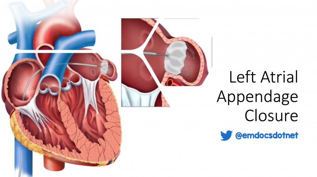 Emdocs Net Emergency Medicine Educationleft Atrial Appendage Closure Procedure Basics