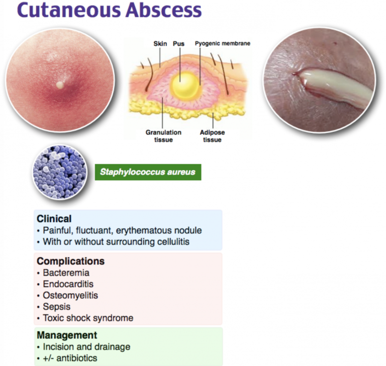 emDOCs.net – Emergency Medicine EducationEM@3AM: Abscess - emDOCs.net ...