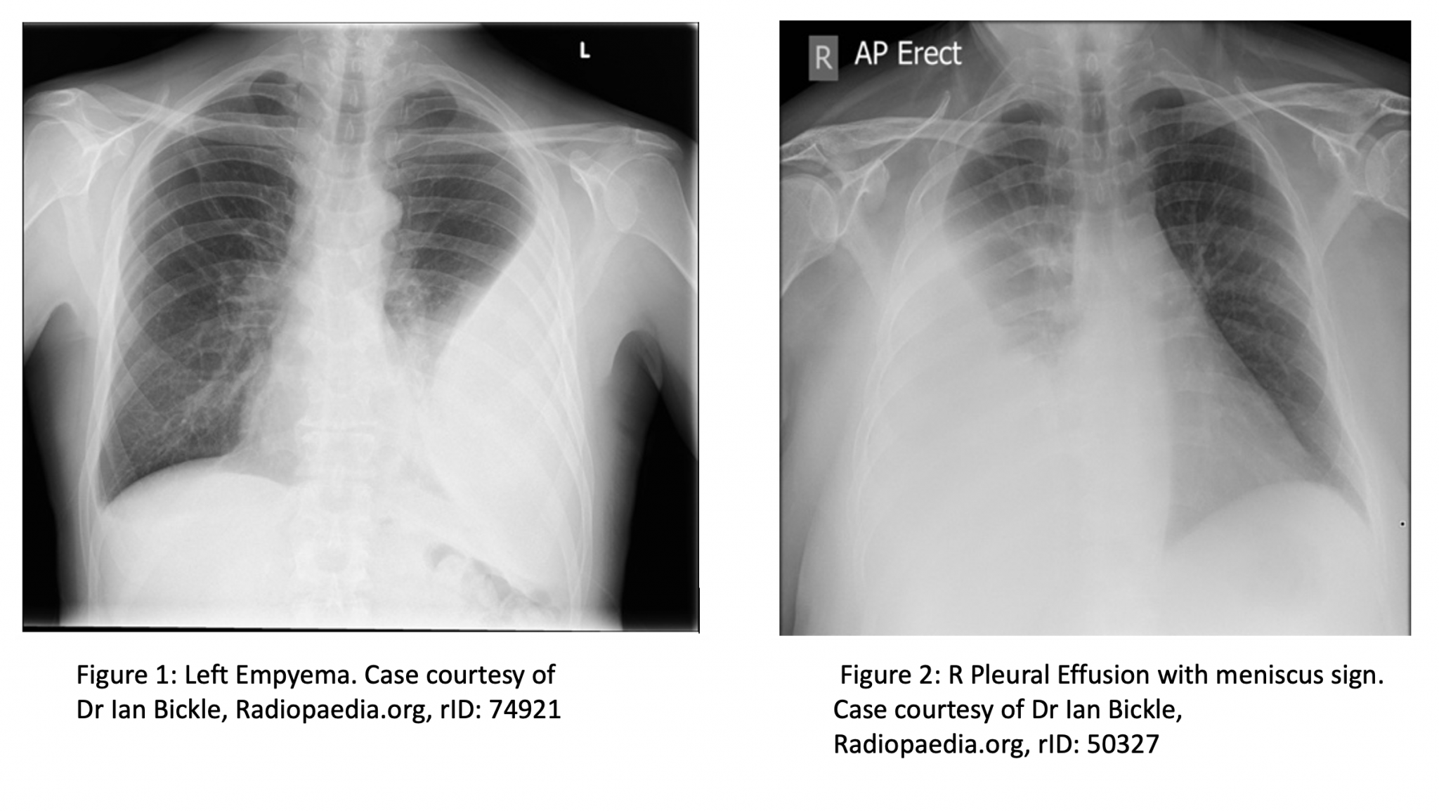 emDOCs.net – Emergency Medicine EducationEmpyema: ED Presentation ...