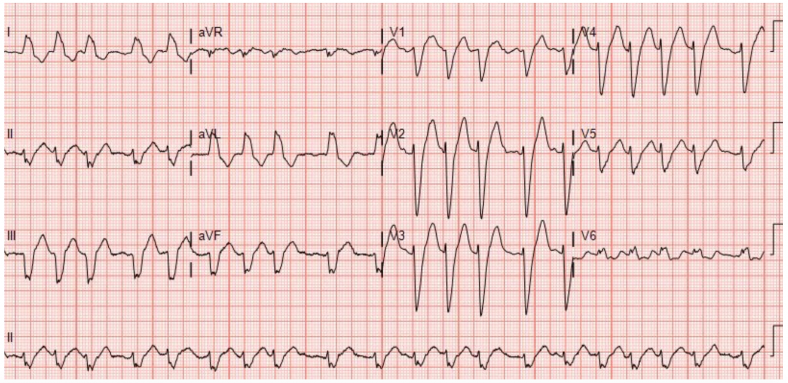 EmDOCs Emergency Medicine EducationECG Pointers Atrial