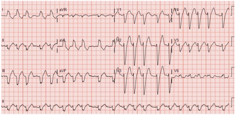 emDOCs.net – Emergency Medicine EducationECG Pointers: Atrial ...