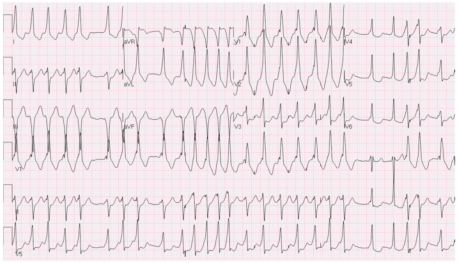 emDOCs.net – Emergency Medicine EducationECG Pointers: Atrial ...