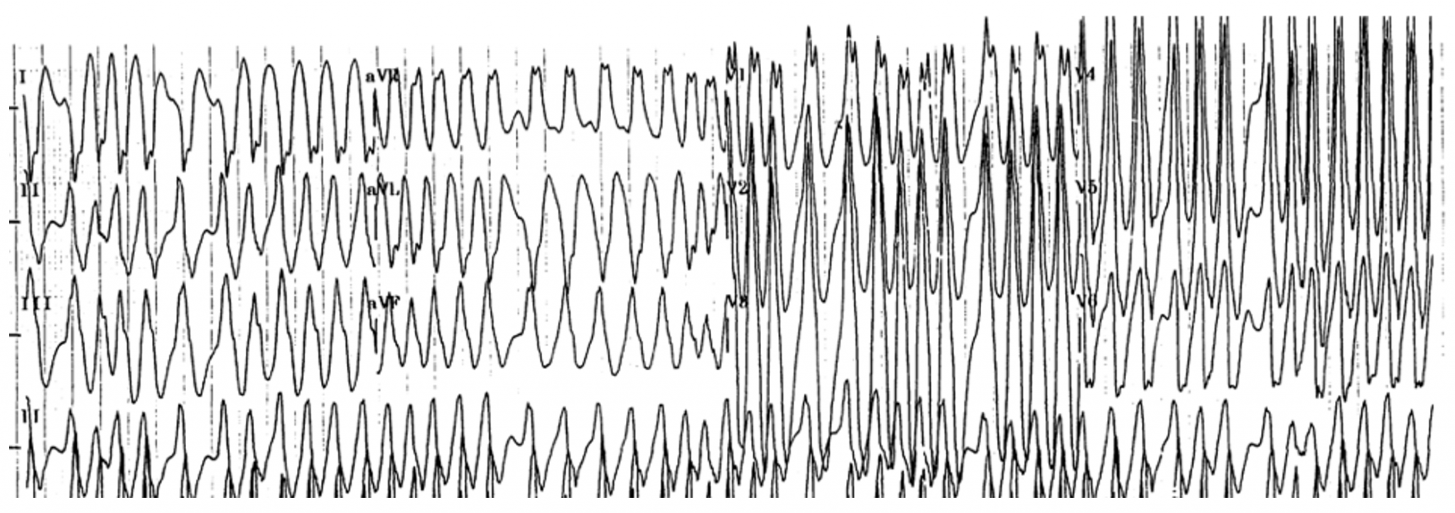 EmDOCs.net – Emergency Medicine EducationECG Pointers: Atrial ...