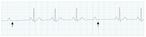 EmDOCs.net – Emergency Medicine EducationECG Pointers: 7 Can’t-Miss ECG ...