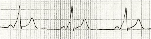 Emdocs.net – Emergency Medicine Educationecg Pointers: 7 Can’t-miss Ecg 