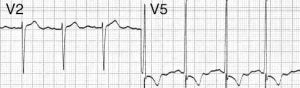 emDOCs.net – Emergency Medicine EducationECG Pointers: 7 Can’t-Miss ECG ...