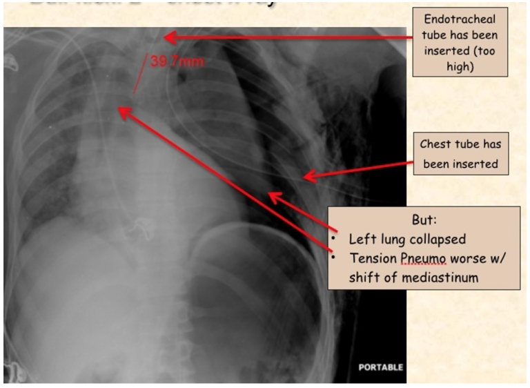 EmDOCs Net Emergency Medicine EducationMedical Malpractice Insights Airway Or Tension