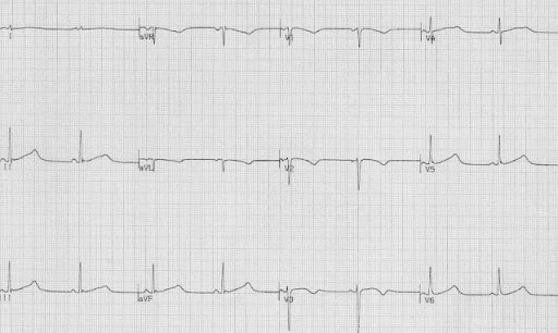 EmDOCs.net – Emergency Medicine EducationECG Pointers: 7 Can’t-Miss ECG ...