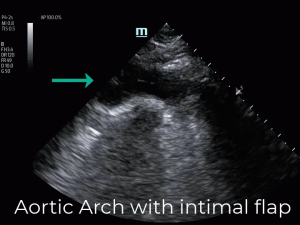 emDOCs.net – Emergency Medicine EducationVid 5 Aortic Arch with intimal ...