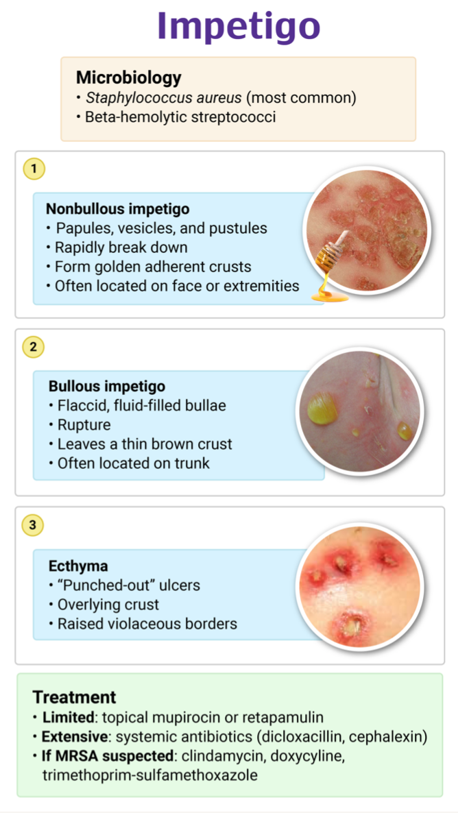 emDOCs.net – Emergency Medicine EducationEM@3AM: Impetigo - emDOCs.net ...