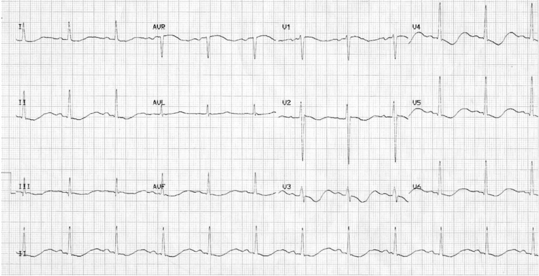 ECG HypoK
