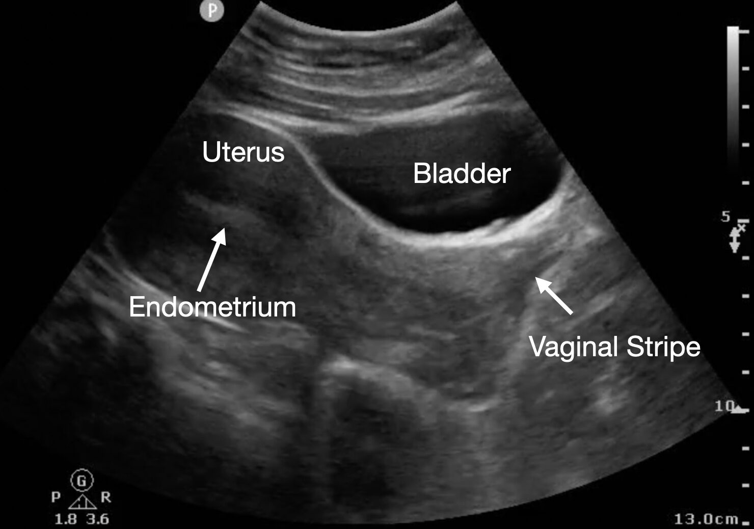 Sagittal view of the uterus in early pregnancy