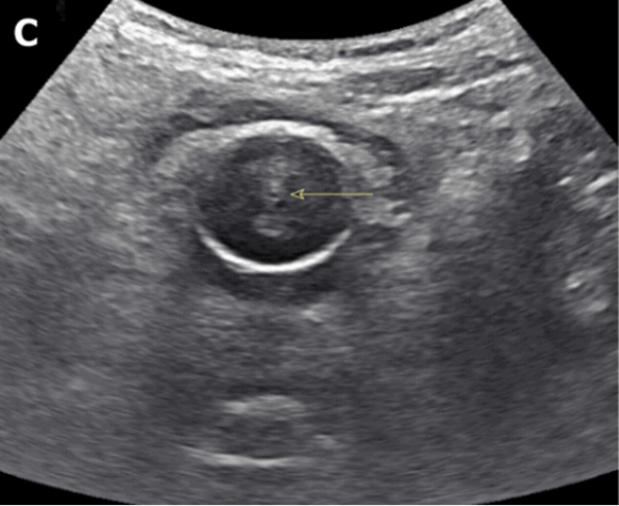 Image 1 CAUTI