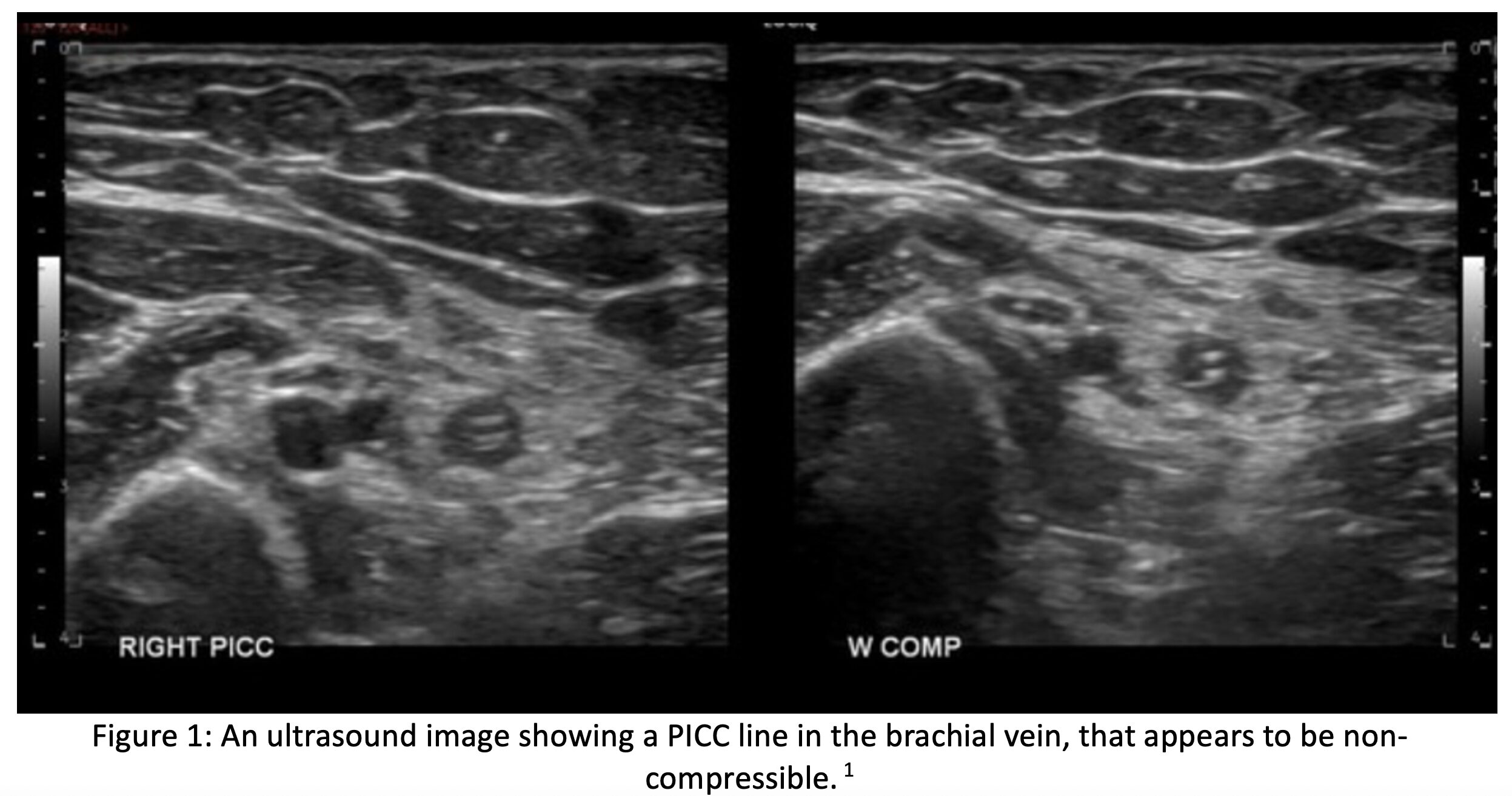 Fig 1 UE DVT