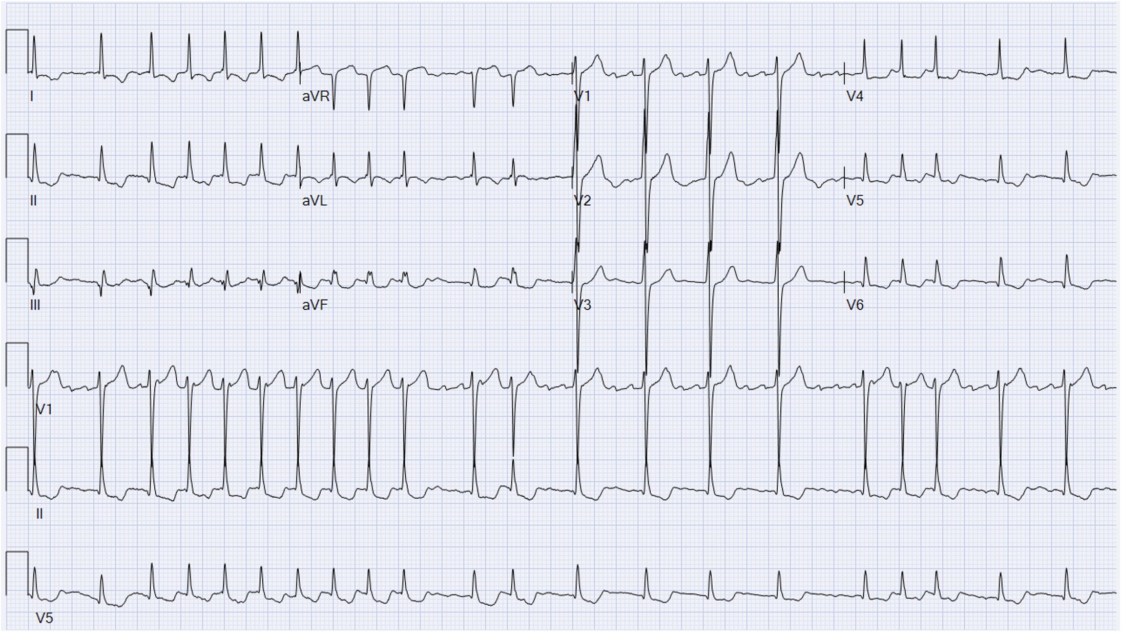 ECG Fontan