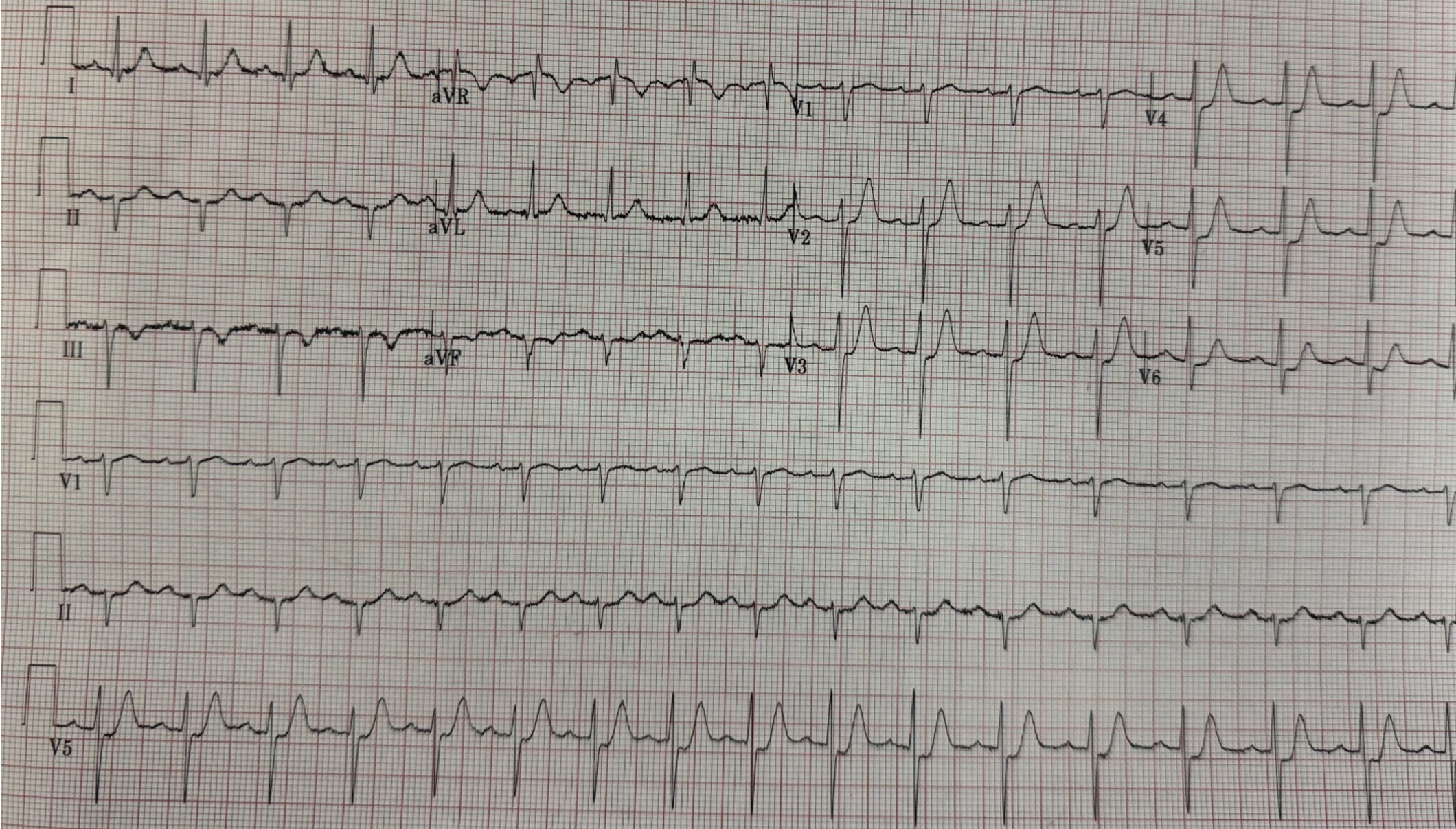 ECG PVT 1
