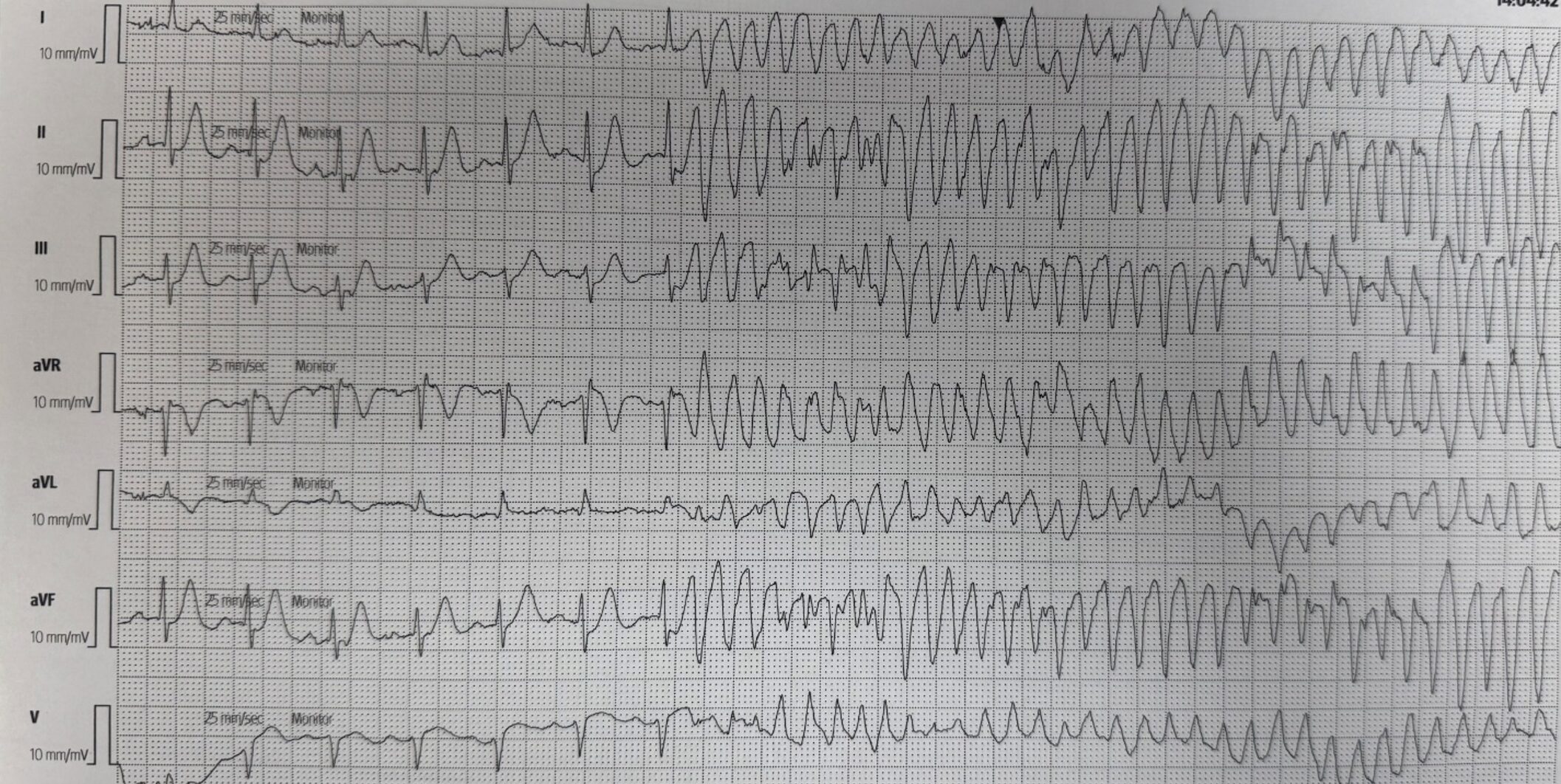ECG PVT 2