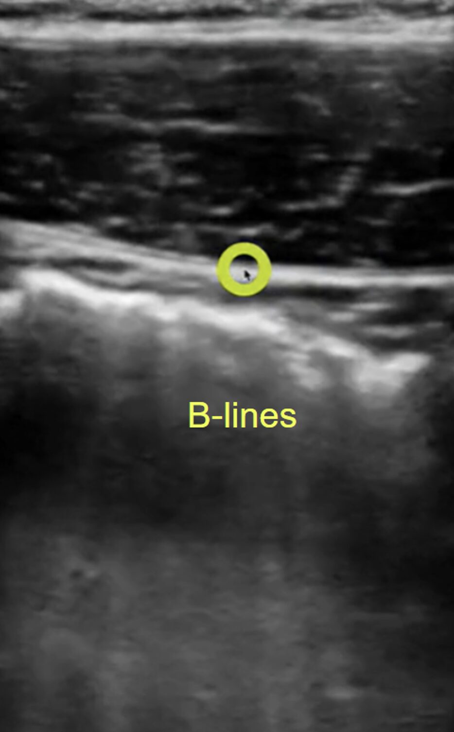 figure 2 perforation