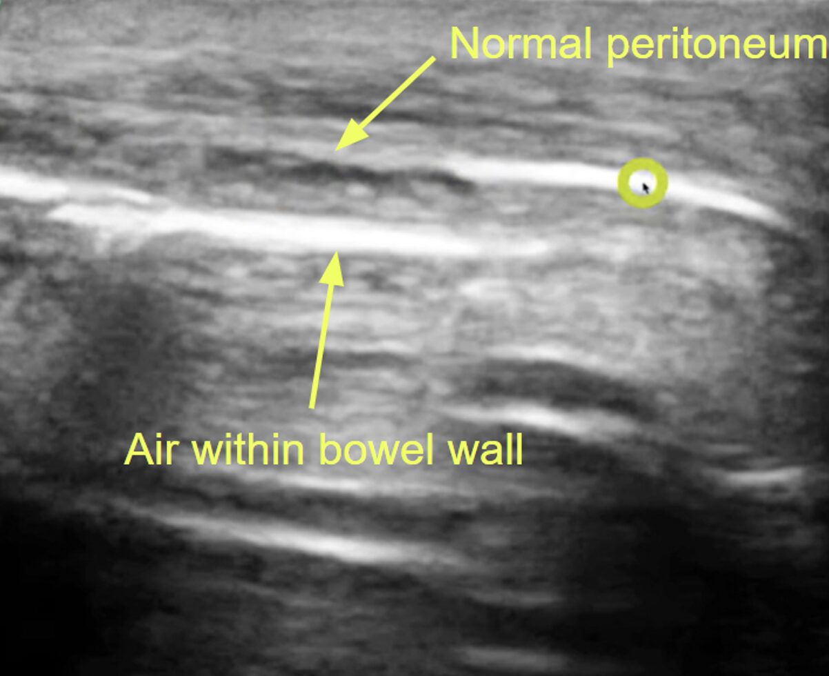 figure 3 perforation