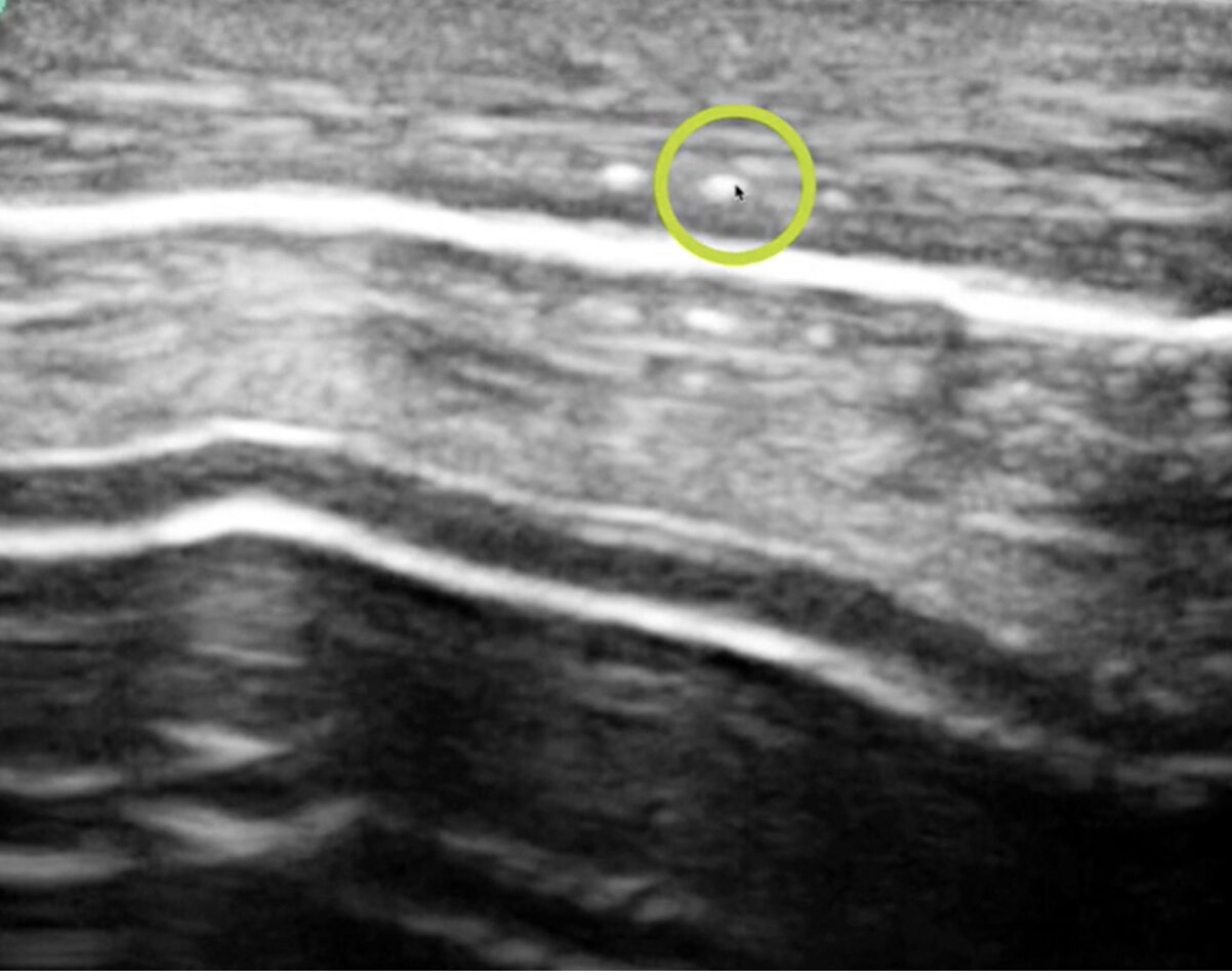 Figure 5 perforation
