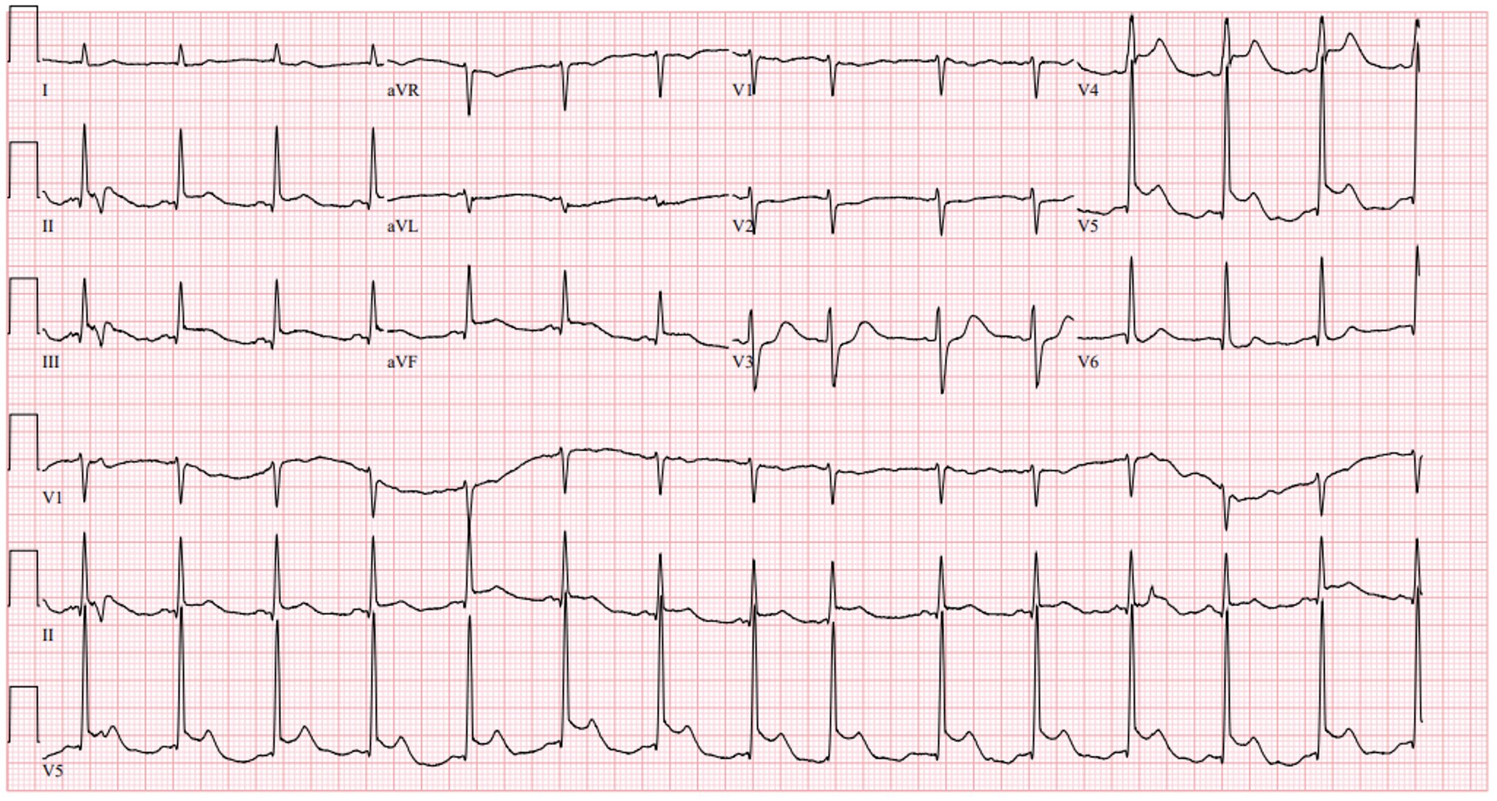 ECG SCAD